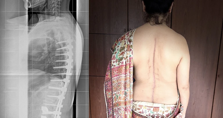 My Back Was Successfully Straightened