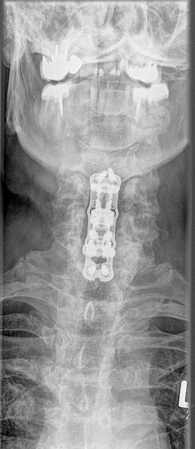 Dr. med. Biren Desai Wirbelsäulenchirurg und Spezialist für die Behandlung komplexer Erkrankungen der Wirbelsäule Köln NRW Deutschland