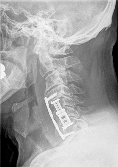 Dr. med. Biren Desai Wirbelsäulenchirurg und Spezialist für die Behandlung komplexer Erkrankungen der Wirbelsäule Köln NRW Deutschland