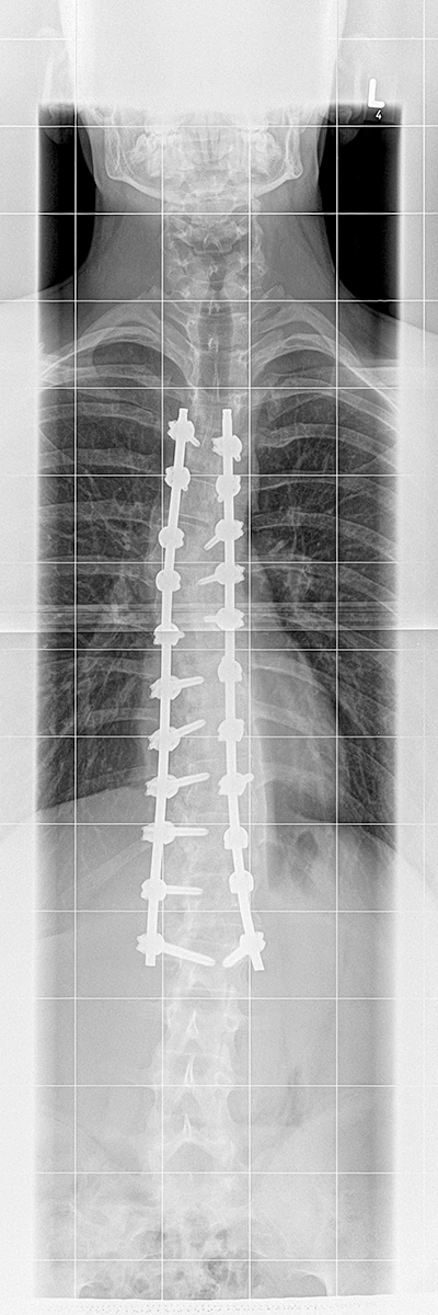 Röntgenbild Post-OP