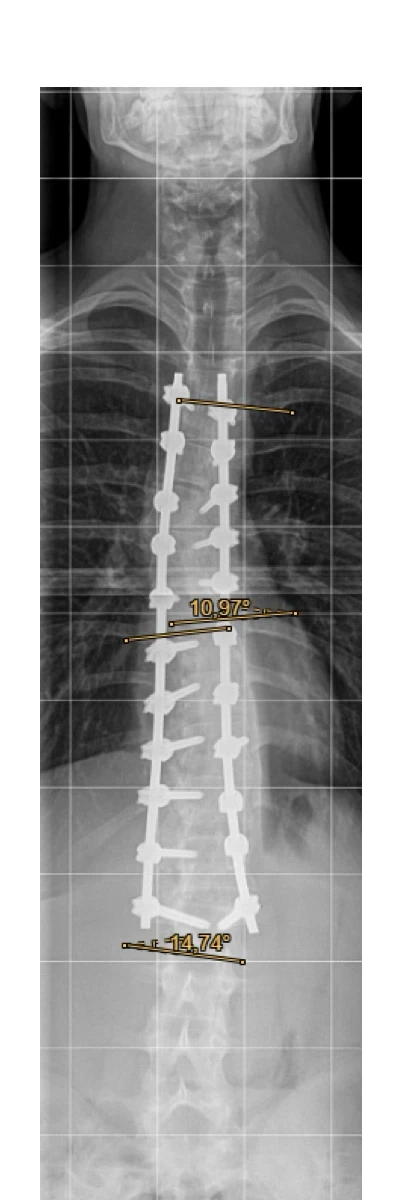 Post-OP Röntgenbild<br>mit Cobb-Winkel