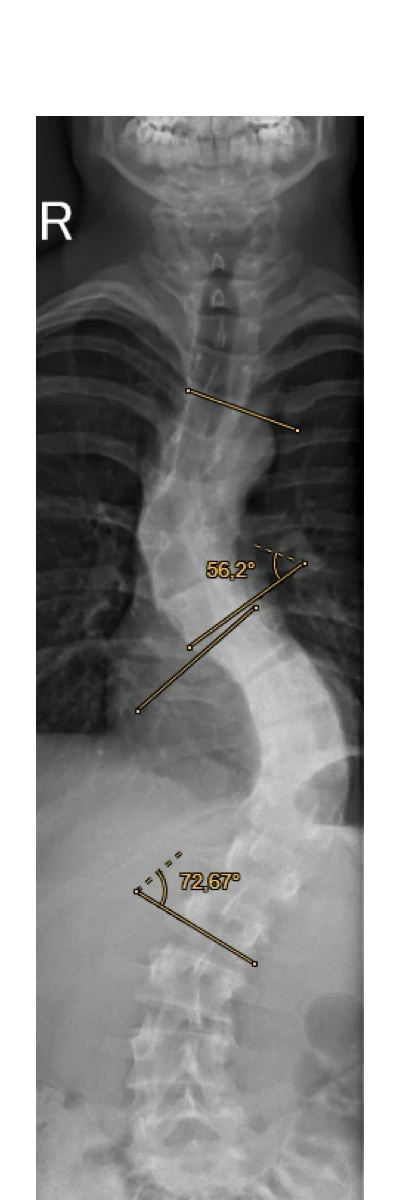 Pre-OP Röntgenbild mit Cobb-Winkel