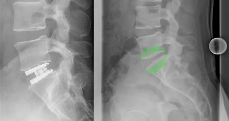 Dr. med. Biren Desai Wirbelsäulenchirurg und Spezialist für die Behandlung komplexer Erkrankungen der Wirbelsäule Köln NRW Deutschland