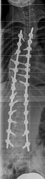 Dr. med. Biren Desai Wirbelsäulenchirurg und Spezialist für die Behandlung komplexer Erkrankungen der Wirbelsäule Köln NRW Deutschland