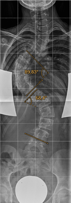 Dr. med. Biren Desai Wirbelsäulenchirurg und Spezialist für die Behandlung komplexer Erkrankungen der Wirbelsäule Köln NRW Deutschland