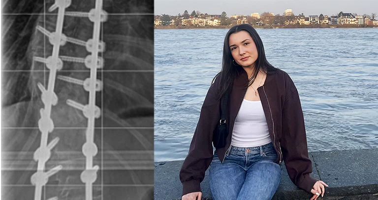 Dr-Desai-Meine-90-Grad-Skoliose