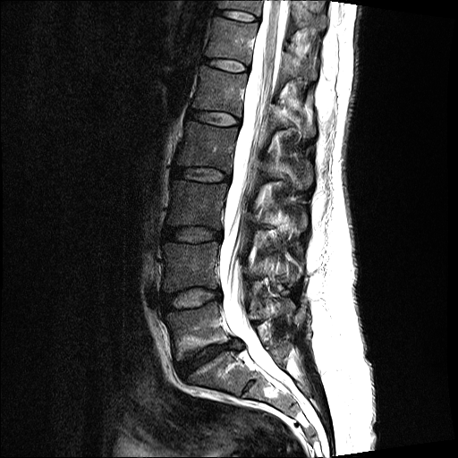 Dr-Desai-kuenstlichen Bandscheibe-L5S1