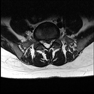 Dr-Desai-kuenstlichen Bandscheibe-L5S1