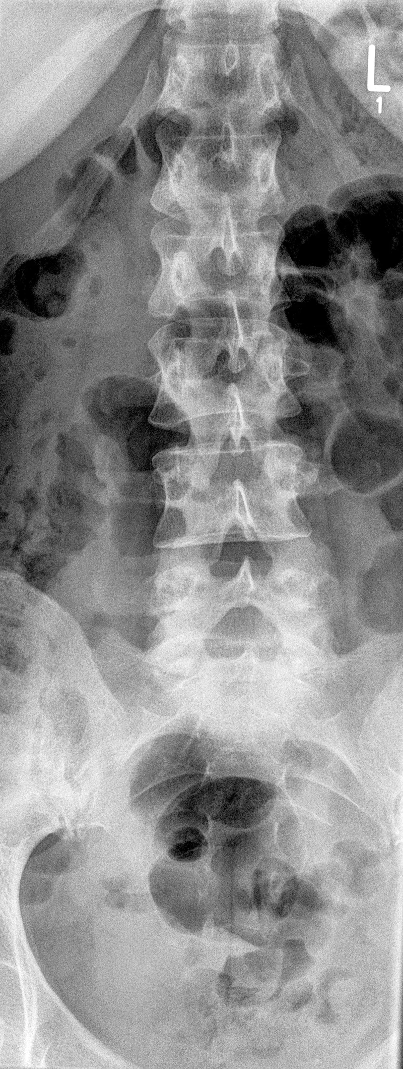 Dr-Desai-kuenstlichen Bandscheibe-L5S1