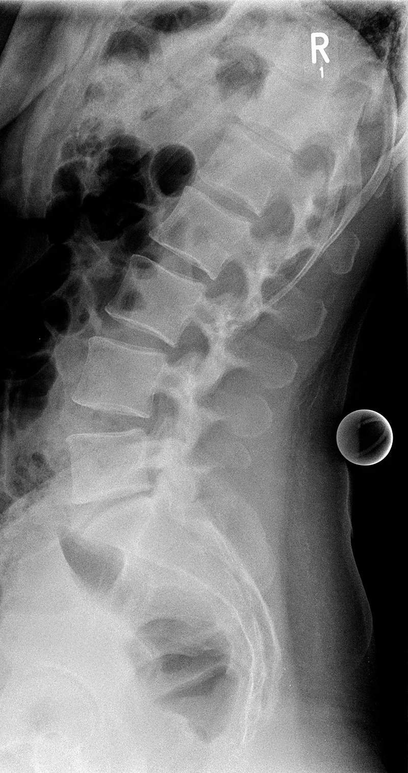 Dr-Desai-kuenstlichen Bandscheibe-L5S1