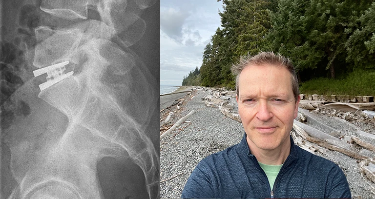 From Herniated Disc to Disc Replacement: A Patient's Journey Back to an Active Life