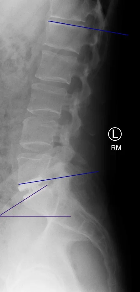 From Herniated Disc to Disc Replacement: A Patient's Journey Back to an Active Life