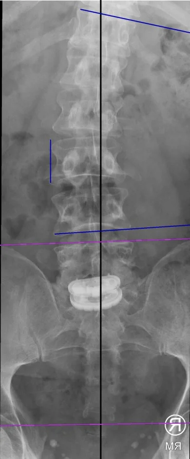 From Herniated Disc to Disc Replacement: A Patient's Journey Back to an Active Life