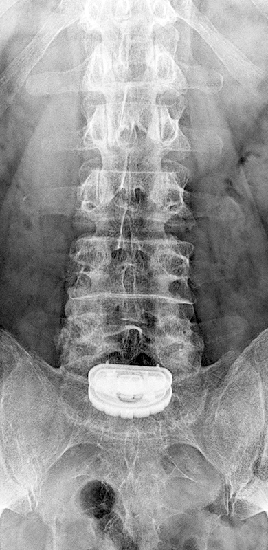 Nach über 40 Jahren mit unberechenbaren Rückenschmerzen hat Dale dank Dr. Biren Desai und einer Bandscheibenprothese an L5-S1 sein Leben zurückgewonnen.