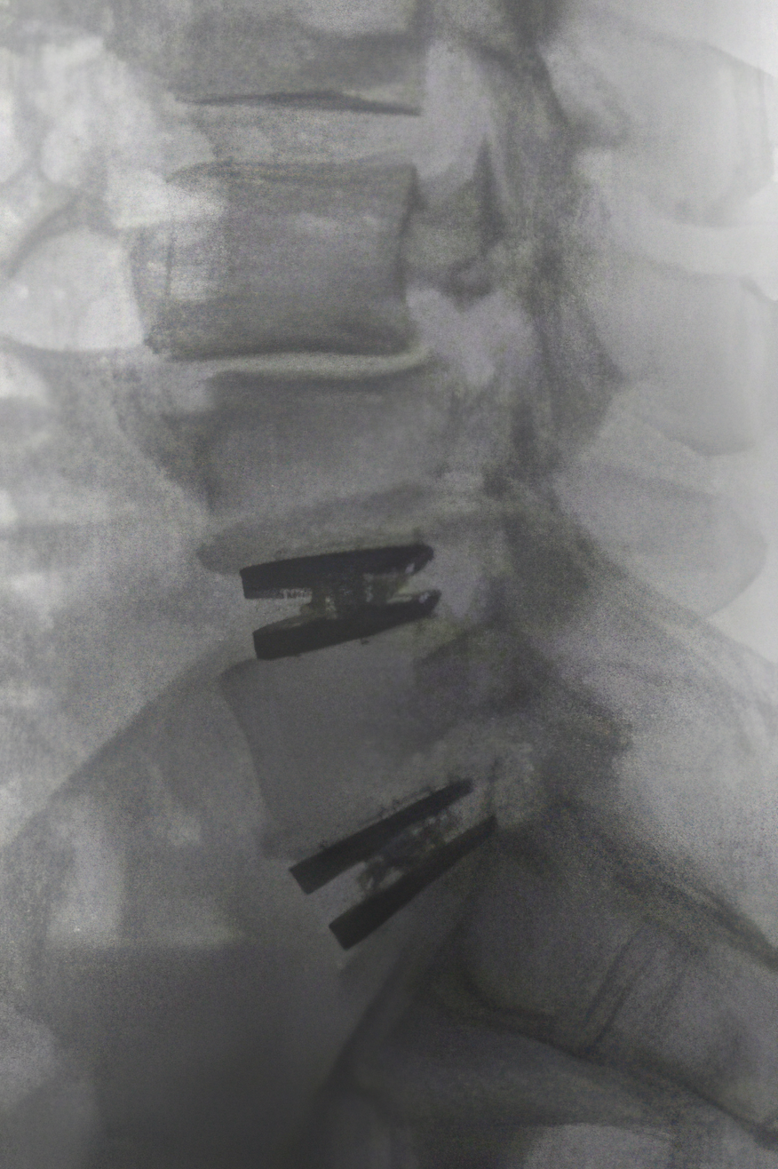 post-op-bisegmentale-bandscheibenprothese